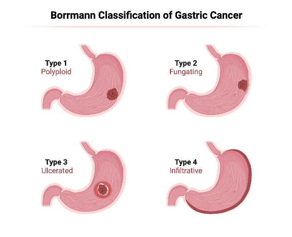 Borromann classification-Webp