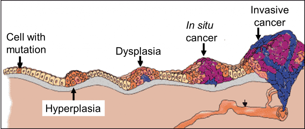 How does cancer progress-webp