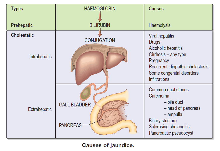 causes of jaundice-webp