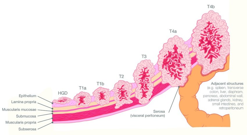 TNM Stafging for tumor cancer-Webp