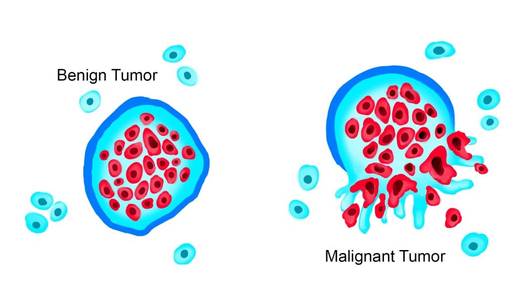 Benign tumors and Malignant tumors-webp
