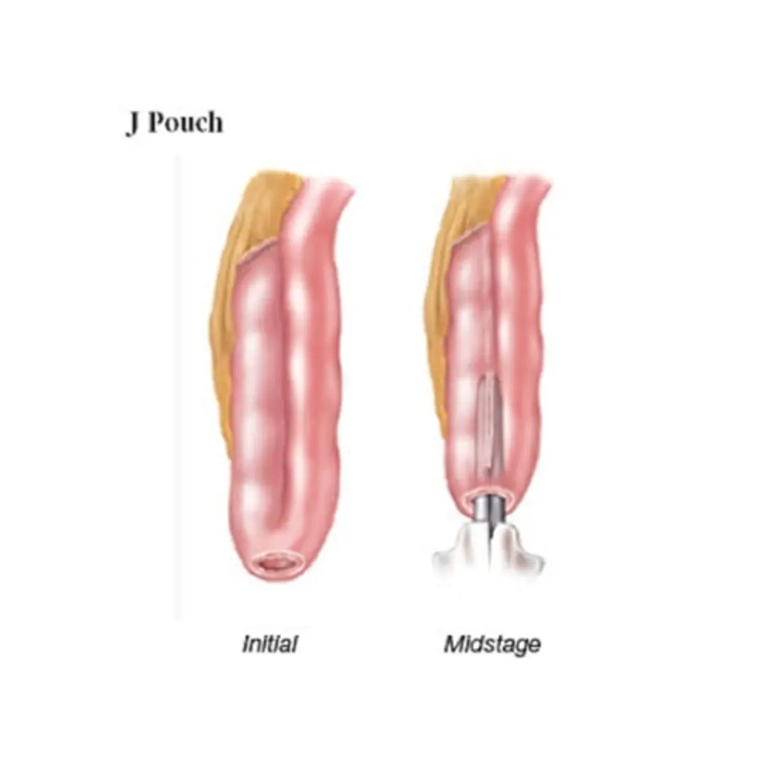 operations for ulcerative colitis